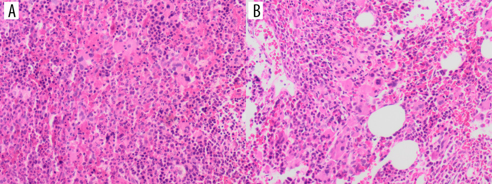 (A) Bone marrow biopsy showed hypercellularity ~100% (H&E stain, x50) with myeloid hyperplasia. Megakaryocytes are seen with variable sizes, and morphology includes dwarf forms and multiple erythroid islands. (B) Megakaryocytes are increased and show small loose clusters.
