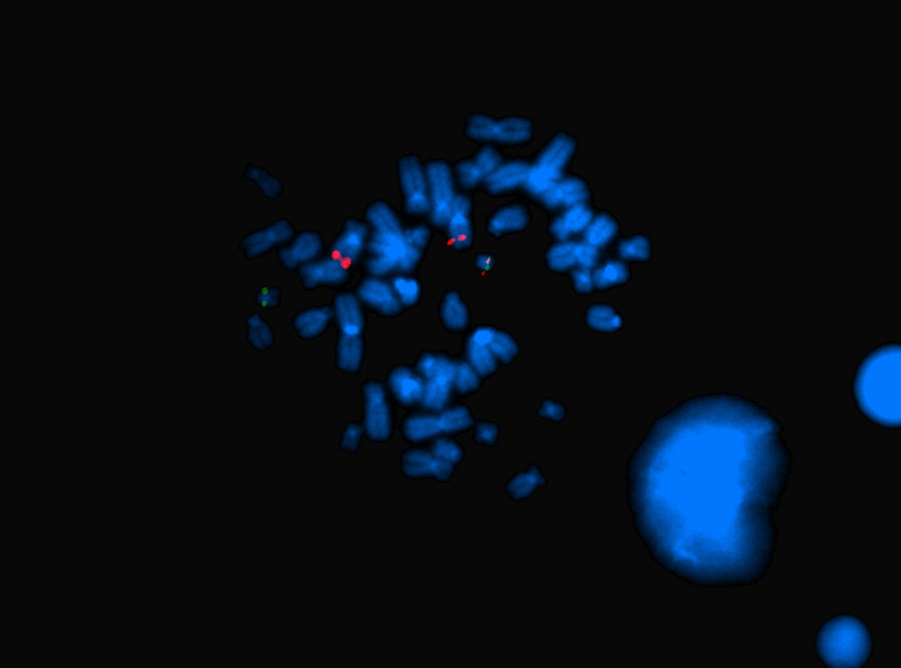 FISH analysis of a metaphase cell with LSI BCR/ABL revealed the following signal distribution: 2 signals for ABL on both chromosomes 9 (red), 1 signal for BCR on 1 chromosome 22 (green), and 1 fusion signal on the derivative chromosome 22.