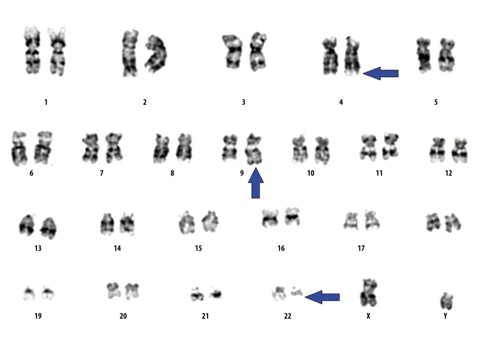Chromosomal analysis revealed the presence of variant Philadelphia chromosome as a result of 3-way translocation between the long arms of chromosome 4,9 and 22 at bands 4q31,9q34, and 22q11.2 (arrows).