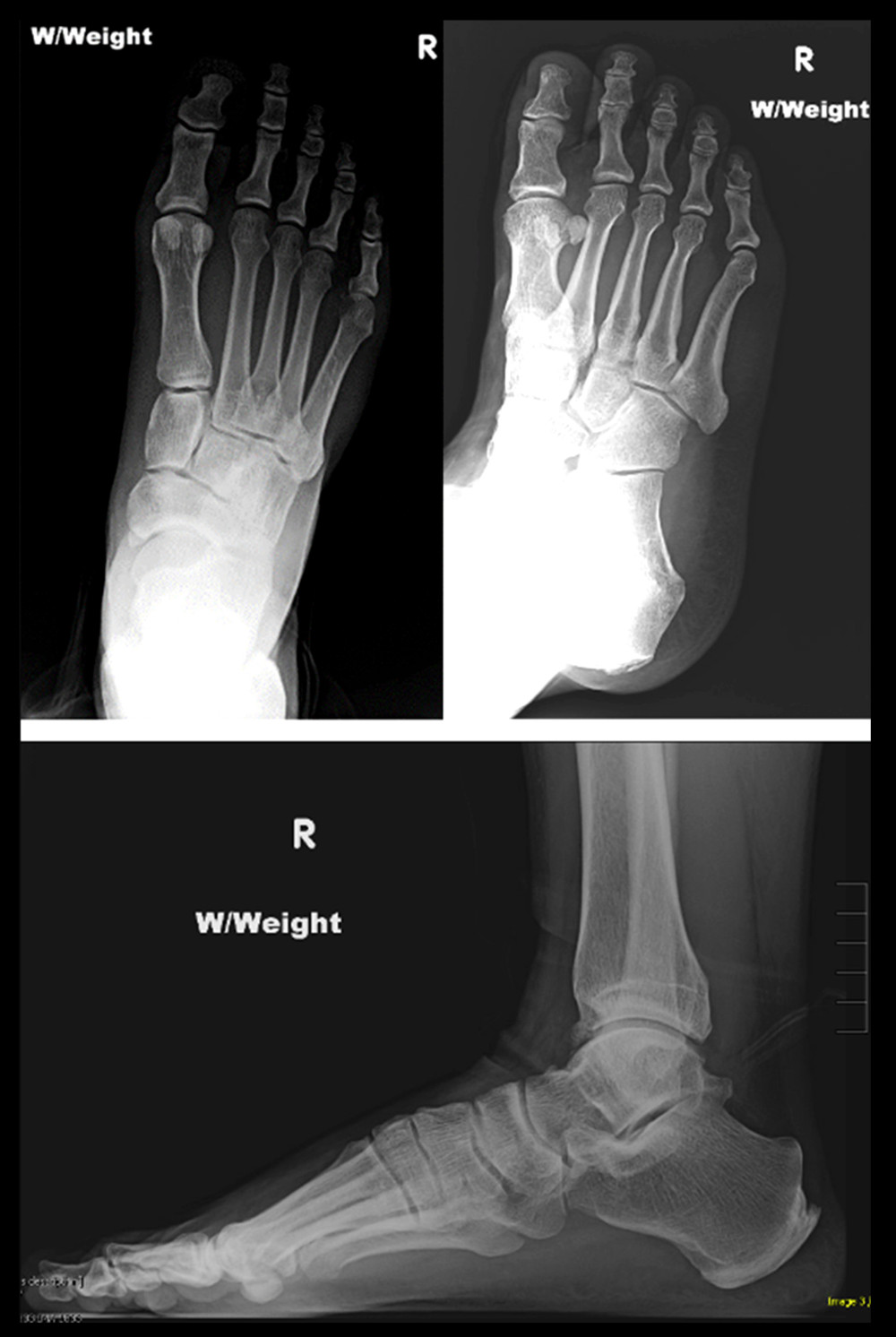 AP, oblique and sagittal radiographic views of the right foot and ankle showing no bone involvement in relation to the dorso-lateral mass.