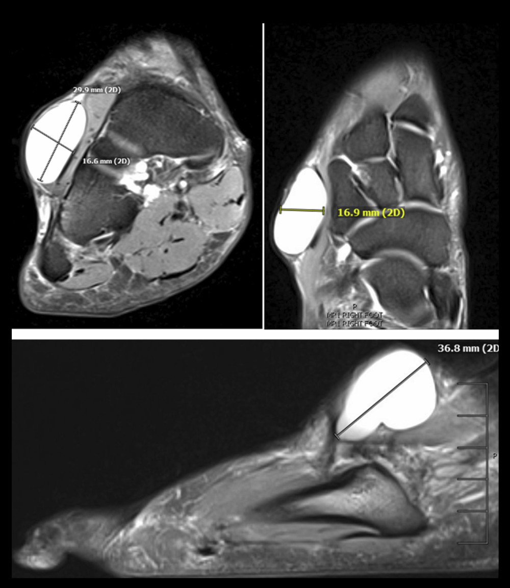 T2 coronal (left), axial (right) and sagittal (inferior) MRI views of the right foot showing the extension of a tumor compatible with a cystic mass.