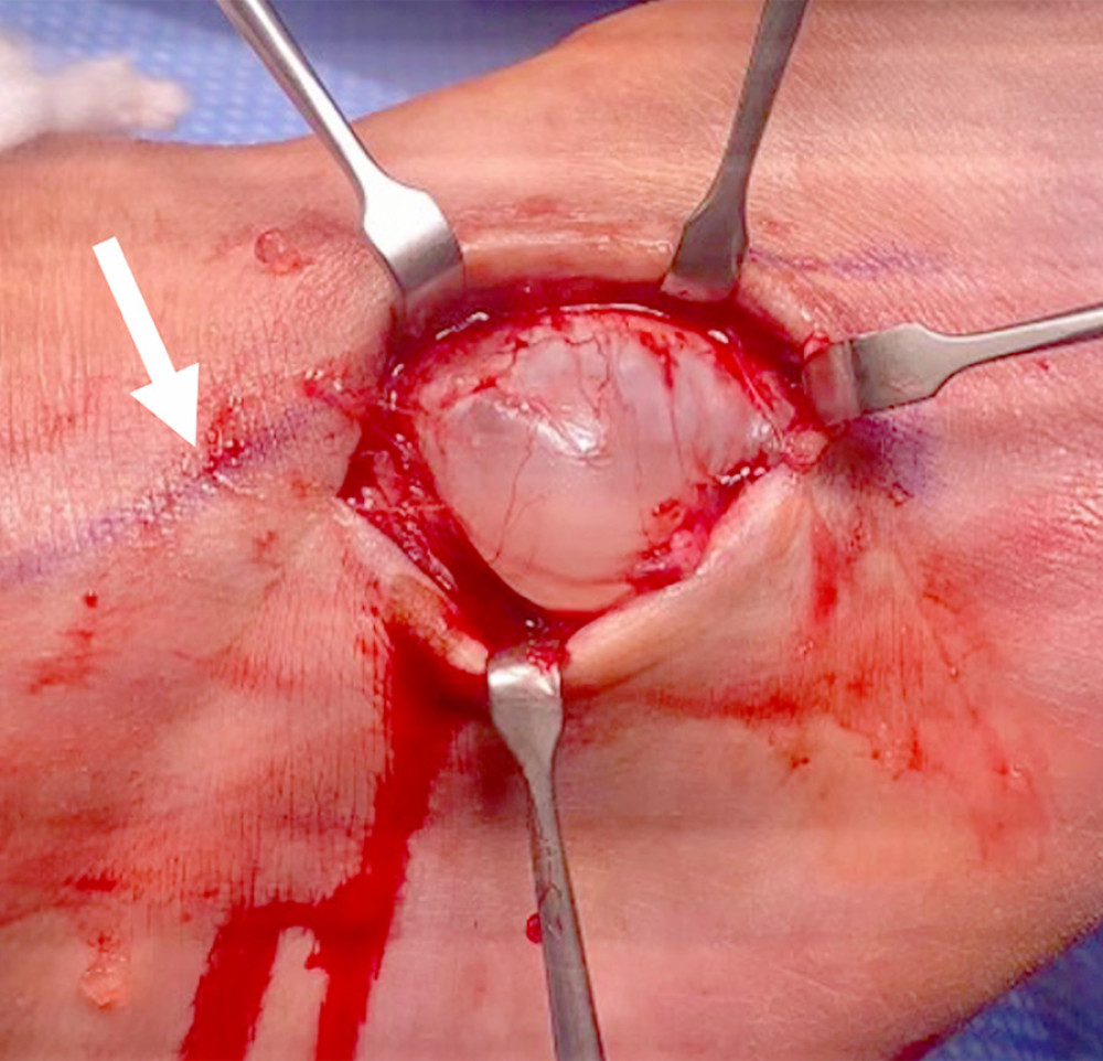 Dorso-lateral approach lateral to the superficial peroneal nerve course (white arrow) showing a cystic mass with complete preservation of pseudo-capsule.