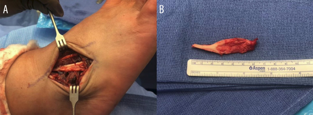 (A) Excised cyst demonstrating an intrasubstance tear of the peroneus tertius tendon. (B) Complete resection of cyst and pseudo-membrane measuring 6 cm long.