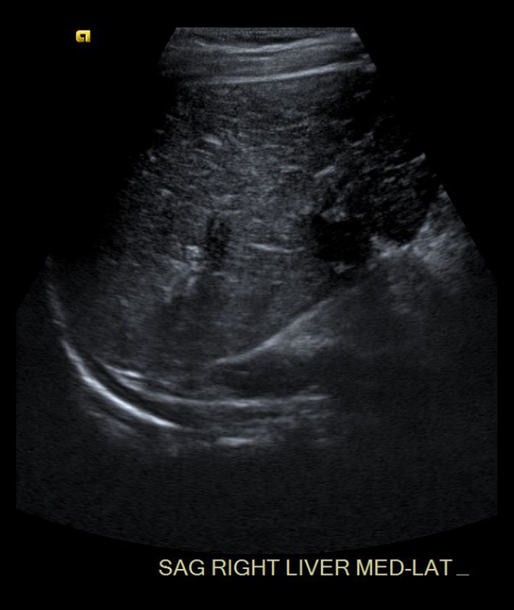 Transverse sonographic image of the liver demonstrates diffusely heterogeneous/coarsened architecture suggesting underlying hepatocellular disease.