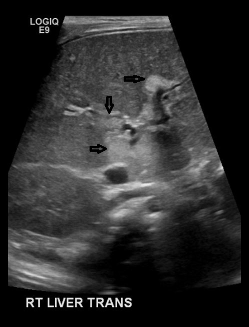 Transverse sonographic image of the liver in the periportal region shows ill-defined hyper-echoic regions adjacent to the portal vessels (arrows) which can reflect periportal fibrosis.