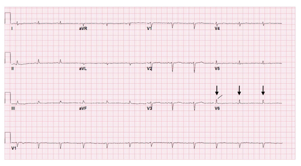 EKG of patient at admission showing low-voltage QRS and electrical alternans as shown by the solid black arrows.