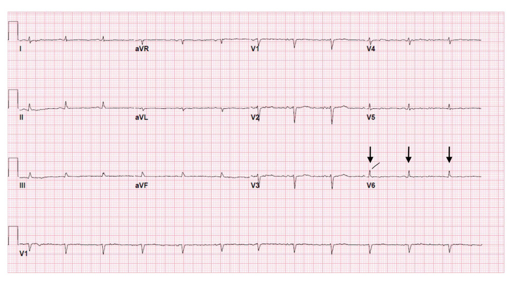 EKG of patient at admission showing low-voltage QRS and electrical alternans as shown by the solid black arrows.
