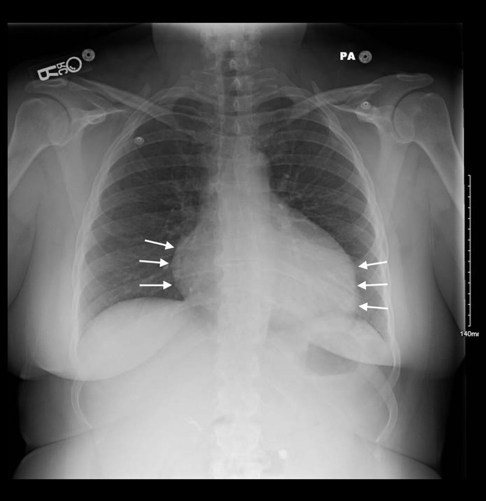 Chest X-ray of patient at admission showing cardiomegaly with boot-shaped appearance as demarcated by the solid white arrows.
