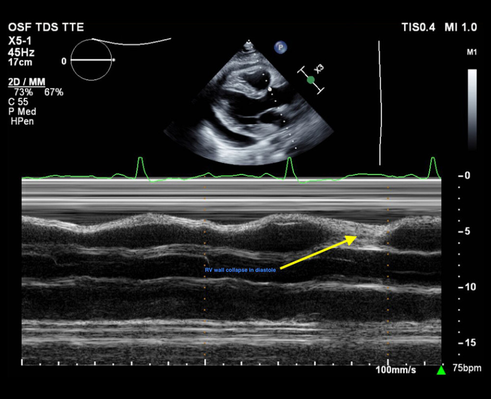 Parasternal long axis M-mode showing collapse of the free right ventricular wall in diastole as portrayed by the solid yellow arrow.