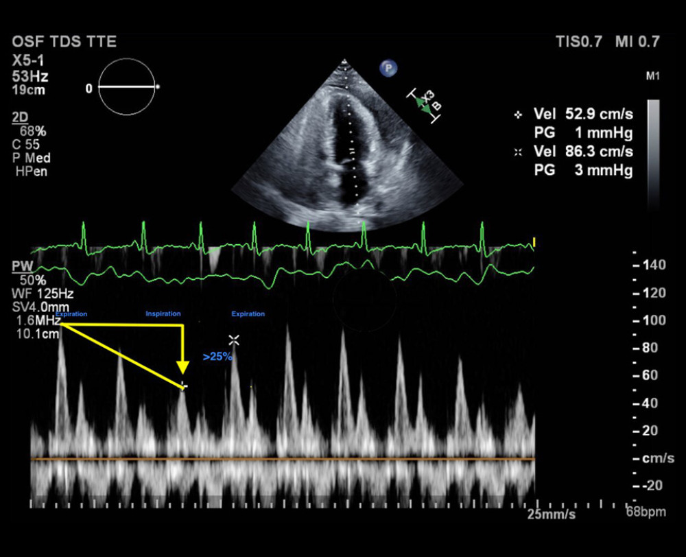 Apical 4-chamber view pulsed wave Doppler interrogation of the mitral valve showing significant respiratory variation (>25%) of the mitral inflow velocities as shown by the solid yellow lines and arrow.