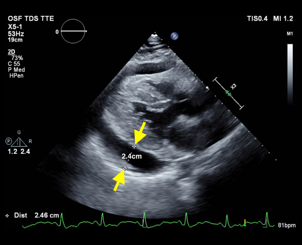 Parasternal long axis view showing large effusion with 2.4 cm posteriorly between the 2 solid yellow arrows.