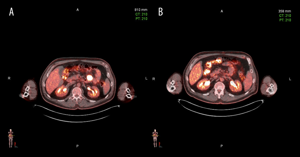Case 1: (A) PET/CT obtained on November 3, 2020, showing a 31×24-mm FDG-avid mesenteric nodal mass in the left mid abdomen consistent with active nodal metastasis. (B) PET/CT obtained on December 20, 2022, with no evidence of active metastatic disease.