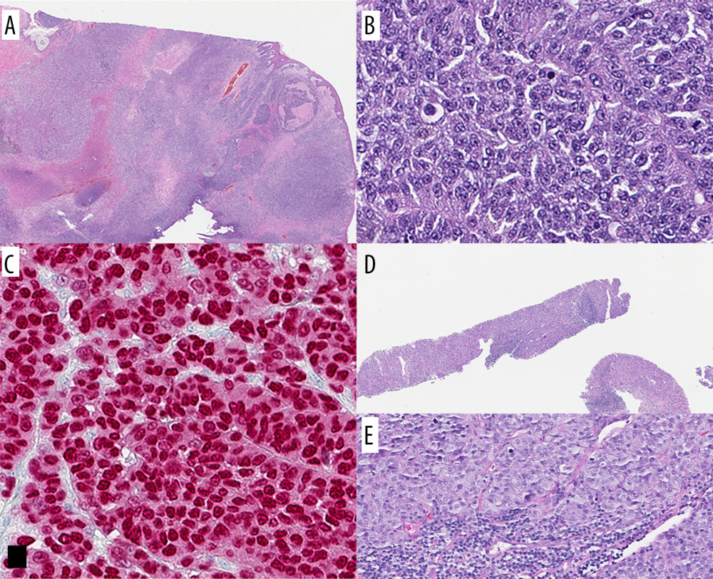 Case 1: Patient’s primary melanoma (A–C) and metastatic melanoma (D, E). Hematoxylin and eosin stain of primary melanoma from mid back (A, 5×). Tumor cells show nuclear atypia with mitotic activity (B, 200×) and positive immunostain for SOX10 (C, 200×). Needle core biopsy of the left axilla lymph node shows metastatic melanoma associated with lymphoid tissue (D, 20× and E, 200×).
