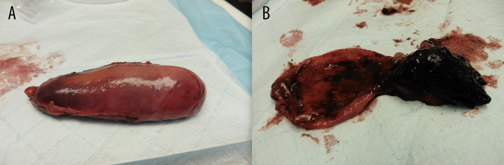 (A, B) Case 2: Gross pathology from laparoscopic cholecystectomy performed on March 17, 2016.