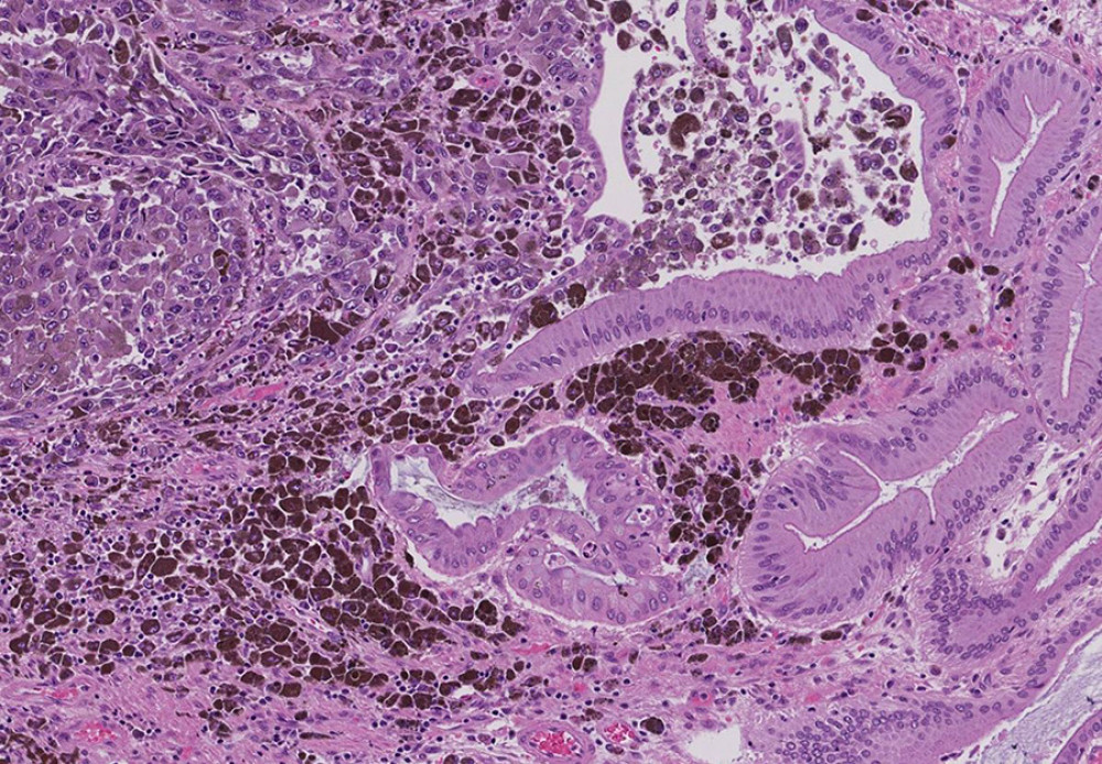 Case 2: Metastatic melanoma composed of epithelioid melanoma cells (left field) involving gallbladder mucosa (right field). The neoplastic cells produce dark-brown melanin pigments (hematoxylin and eosin stain, 100× magnification).