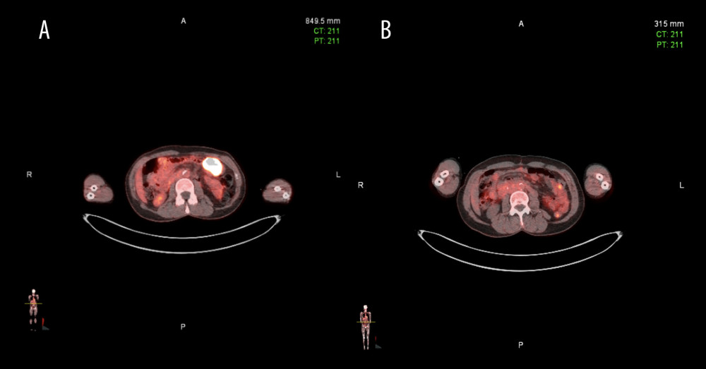 Case 3: (A) PET/CT obtained on October 29, 2020, showing a hypermetabolic mass associated with the small bowel in the left side of the abdomen is consistent with metastatic melanoma. (B) PET/CT obtained on May 27, 2021, status post-surgical resection of small bowel without evidence of local recurrence.