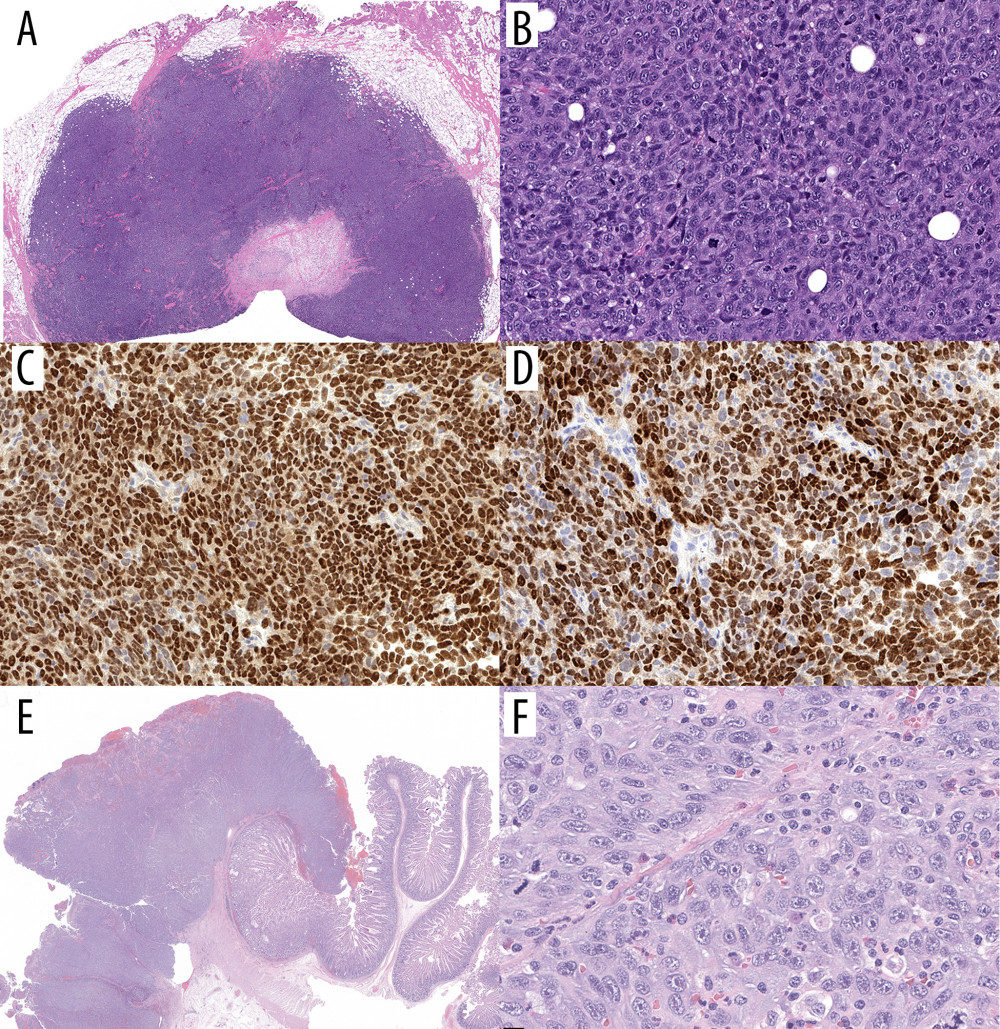 Case 3: (A) Excisional biopsy of the subcutaneous nodule showing a hypercellular lesion centered in the subcutis with peripheral infiltration of fat (hematoxylin and eosin [H&E], original magnification ×7). (B) The tumor cells show nuclear pleomorphism and prominent mitotic activity (H&E, ×200). Immunohistochemical staining confirms metastatic melanoma with (C) diffuse SOX10 (immunohistochemistry [IHC], ×200) and (D) MiTF positivity (IHC, ×200). (E) A subsequent small bowel metastasis presents as an irregular tumor nodule involving the mucosa and submucosa (H&E, ×5). (F) Higher magnification demonstrates similar features, with nuclear pleomorphism and mitotic activity (H&E, ×400).