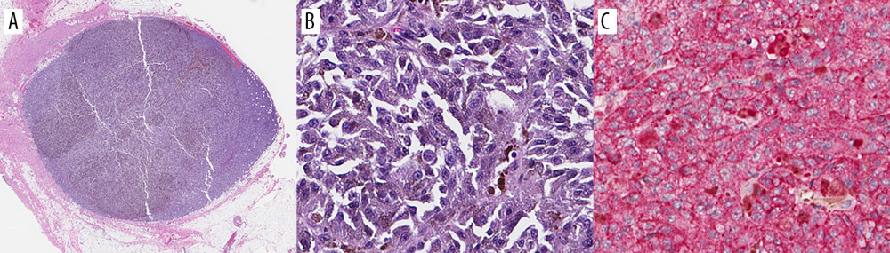 Case 4: Patient’s lymph node specimen from left axillary contents shows metastatic melanoma replacing the lymph node; H&E stains, (A) 5×, and (B) 200×. (C) Tumor cells show positive immunostain for MelanA (200×).