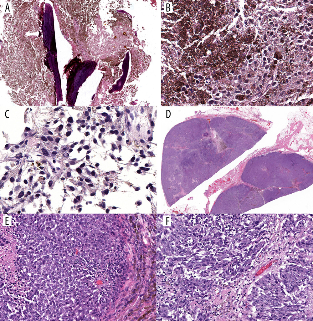 Case 5: (A) A right femur biopsy demonstrates sheets of melanin-laden macrophages surrounding cancellous bone (hematoxylin and eosin [H&E], original magnification ×40). (B) On higher magnification, scattered hyperchromatic, histologically viable melanoma tumor cells are present in a background of necrosis and melanin pigment (H&E, ×320). (C) A concurrent lung biopsy shows vaguely spindle shaped melanoma tumor cells with intranuclear pseudo-inclusions (H&E, ×400). (D) Low magnification a subsequent axillary lymph node resection specimen demonstrates lymph node profiles largely replaced by metastatic melanoma (H&E, ×5). (E) Necrosis (left portion of image) and melanin pigment (right portion of image) are present (H&E, ×200). (F) A subsequent small bowel resection demonstrates metastatic melanoma with a vaguely spindle cell pattern (H&E, ×200).