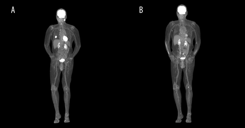 Case 6: (A) PET/CT obtained on July 14, 2020, showing a highly FDG-avid 1.9-cm left intraparotid lymph node consistent with nodal metastasis and an FDG-avid 3.1-cm right lower lobe lung mass consistent with melanoma metastasis. (B) PET/CT obtained on November 28, 2022, showing no evidence of tumor recurrence or metastasis.