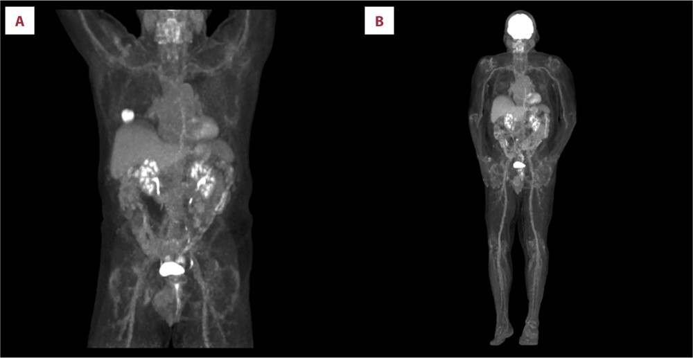 Case 7: (A) PET/CT obtained on May 30, 2019, showing a highly-FDG-avid 2.5-cm right lower lung nodule suspicious for primary lung malignancy versus metastasis. (B) PET/CT obtained on August 27, 2020, showing no evidence of recurrent or metastatic melanoma.