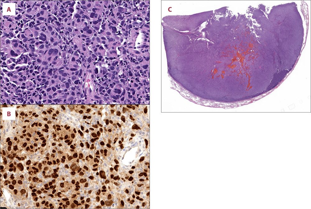 Case 7: (A) A lung biopsy shows metastatic melanoma with prominent nuclear pleomorphism (hematoxylin and eosin [H&E], original magnification ×200) and (B) strong SOX10 staining (immunohistochemistry, ×200). (C) Subsequent lobectomy shows metastatic melanoma with a rounded contour and a peripheral rim of uninvolved lung parenchyma (H&E, ×6).