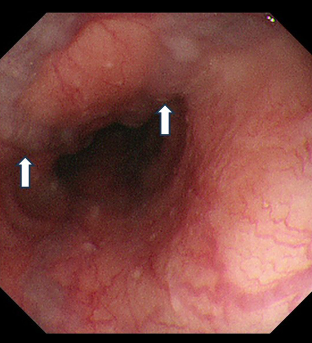Esophageal varices (arrows) revealed by Modified Paquet classification Grade I.
