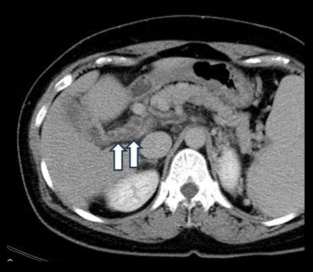 Contrast-enhanced computed tomography showing portal vein thrombosis (arrows).
