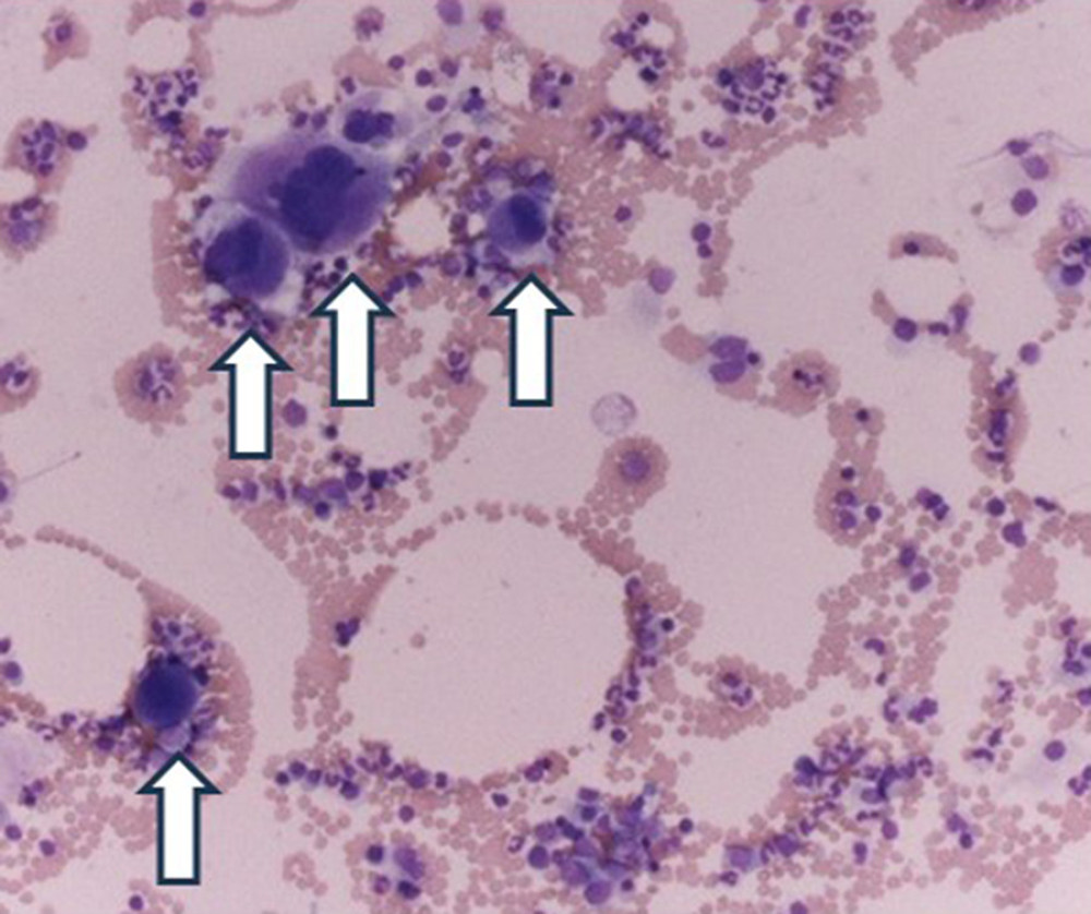 Bone marrow biopsy demonstrating many mature megakaryocytes in the field of view without dysplasia, immature cells, or fibrosis. These megakaryocytes (arrows) had large and irregular nuclei and platelets aggregated (magnification ×100).
