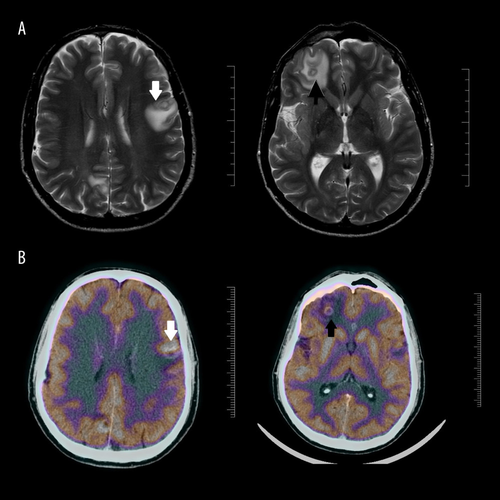 Cranial images showing space-occupying lesions suggestive of brain abscesses. (A) Cranial magnetic resonance imaging of the brain showing increased signal in T2-weighted of the right parietal lobe (white arrow) and left frontal lobe (black arrow). (B) Positron emission tomography imaging showed increased signal at the same locations: in right parietal lobe (white arrow) and left frontal lobe (black arrow).