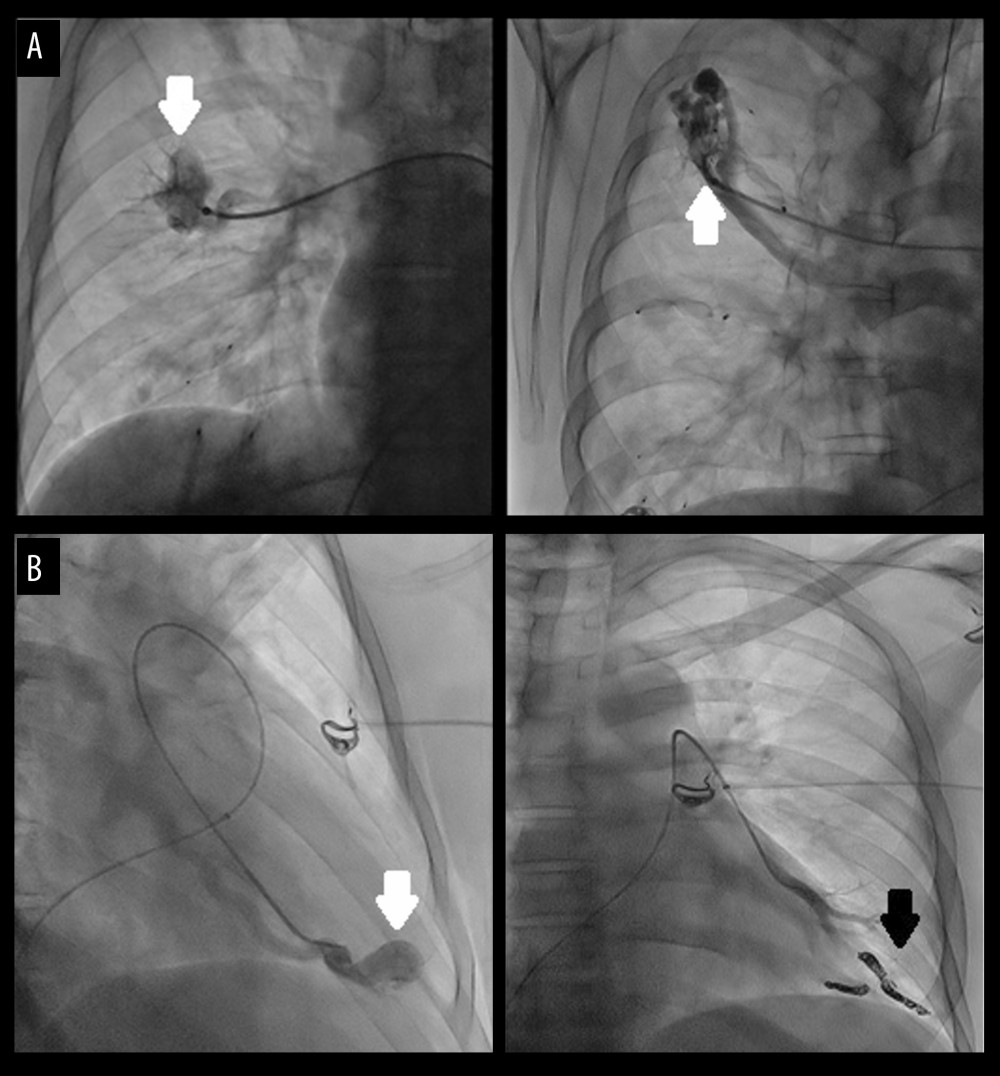 (A, B) Pulmonary images demonstrations the presence of multiple arteriovenous malformations. Chest X-ray showing some pre-embolectomy fluoroscopy images larger than 2 centimeters. Two were localized at the right upper lobe apical segment and 1 at the left lower lobe (white arrows). Post-embolectomy fluoroscopy image at left lower lobe (black arrow).