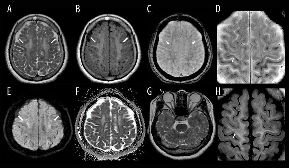 A 29-year-old female patient with VWMD. (A, B) Axial T2-weighted and fluid-attenuated inversion recovery (FLAIR) images shows diffuse and bilateral symmetrical hyperintensity in the cerebral white matter. (C) T2* gradient echo image shows a diffuse, linear, and symmetrical hypointensity in the affected white matter (short arrow). (D) Magnification of an axial GRE T2*-WI apparently reveals diffuse linear juxtacortical white matter hypointensities. (E, F) Diffusion-weighted image reveals diffuse hyperintensity without diffusion restriction on the apparent diffusion coefficient map. (G) Axial T2-WI scan reveals bilateral intraocular lens insertion for congenital cataract (blanked arrow). (H) Magnification of an axial FLAIR image shows relatively spared juxtacortical white matter in the cerebral hemisphere.