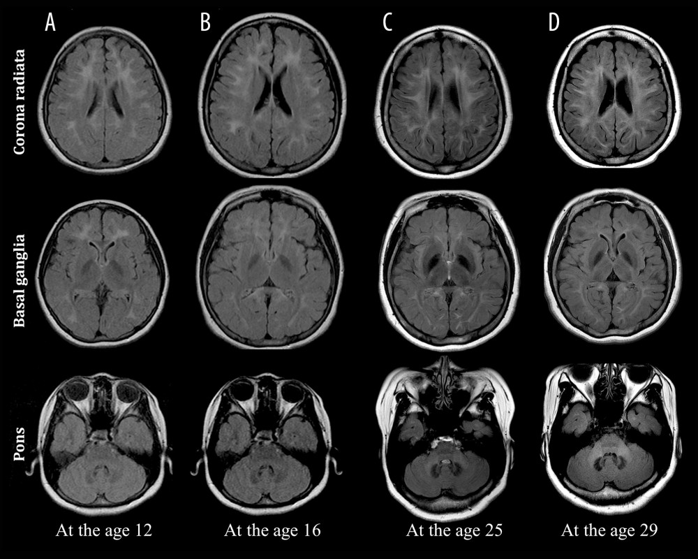 Temporal evolution of VWMD in the patient for 17 years. Serial T2-WI scans of a patient with VWMD. Columns A and B show initial and follow-up MRI images obtained at the ages of 12 and 16 years with symptoms of headache and syncope, respectively. Column C shows images obtained after the onset of motor neurological symptoms, such as hand tremor and upper-extremity weakness, at the age of 25 years, and the column D image was obtained at the age of 29 years due to lower-extremity weakness and severe gait disturbance. Changes in the extent of the lesion over time can be seen at the corona radiata, basal ganglia, and pons levels. In column C, the extent of white matter hyperintensity increased at the corona radiata level, and the invasion of the splenium of the corpus callosum was found. At the level of basal ganglia, there is a distinct dark signal intensity due to iron deposition in the globus pallidus and thalamus. At the level of the pons, dark signal intensity was prominent in the dentate nucleus, and white matter hyperintensity was seen in the cerebellar peduncle in column D.