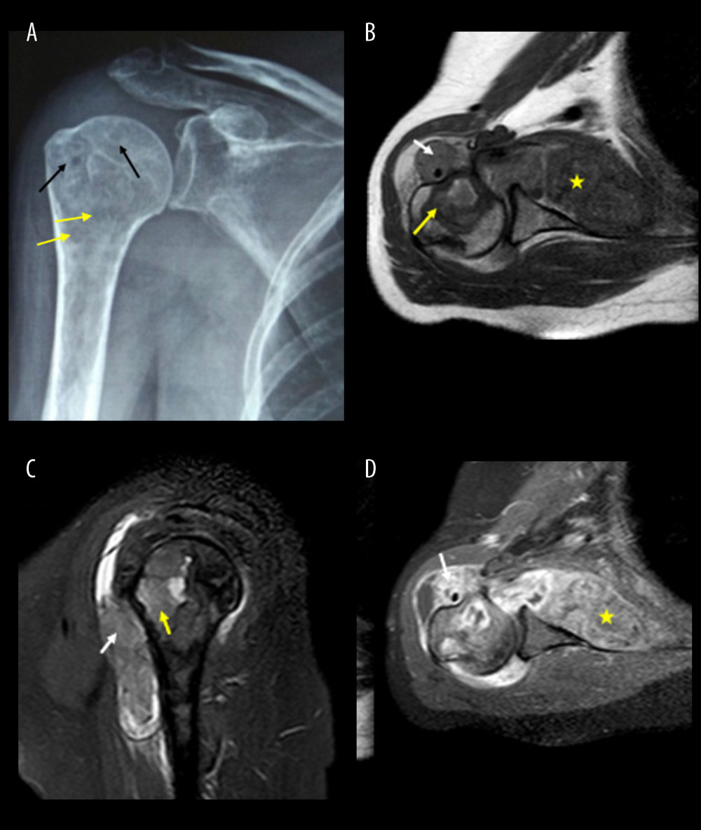 Plain radiograph (A) and magnetic resonance imaging (MRI) (B–D) of the right shoulder. (A) Plain radiograph of shoulder shows lytic bone lesions (yellow arrow), multiple juxta-articular and subchondral cystic lesions (geodes), with well-defined sclerotic margins (black arrow). The joint space width is normal. (B) MRI with axial T1-weighted imaging (T1W), (C) sagittal T2-weighted fat-suppressed imaging (T2FS), and (D) axial T1W imaging after contrast (T1C+) show multiple nodular deposition in synovial membrane of an abnormal soft tissue that have the low signal intensity on T1W, intermediate signal intensity on T2FS, peripheral enhancement on T1C+ (white arrow). These substances also fill the subchondral defects (yellow arrow) and extend to periarticular soft tissue (yellow star).
