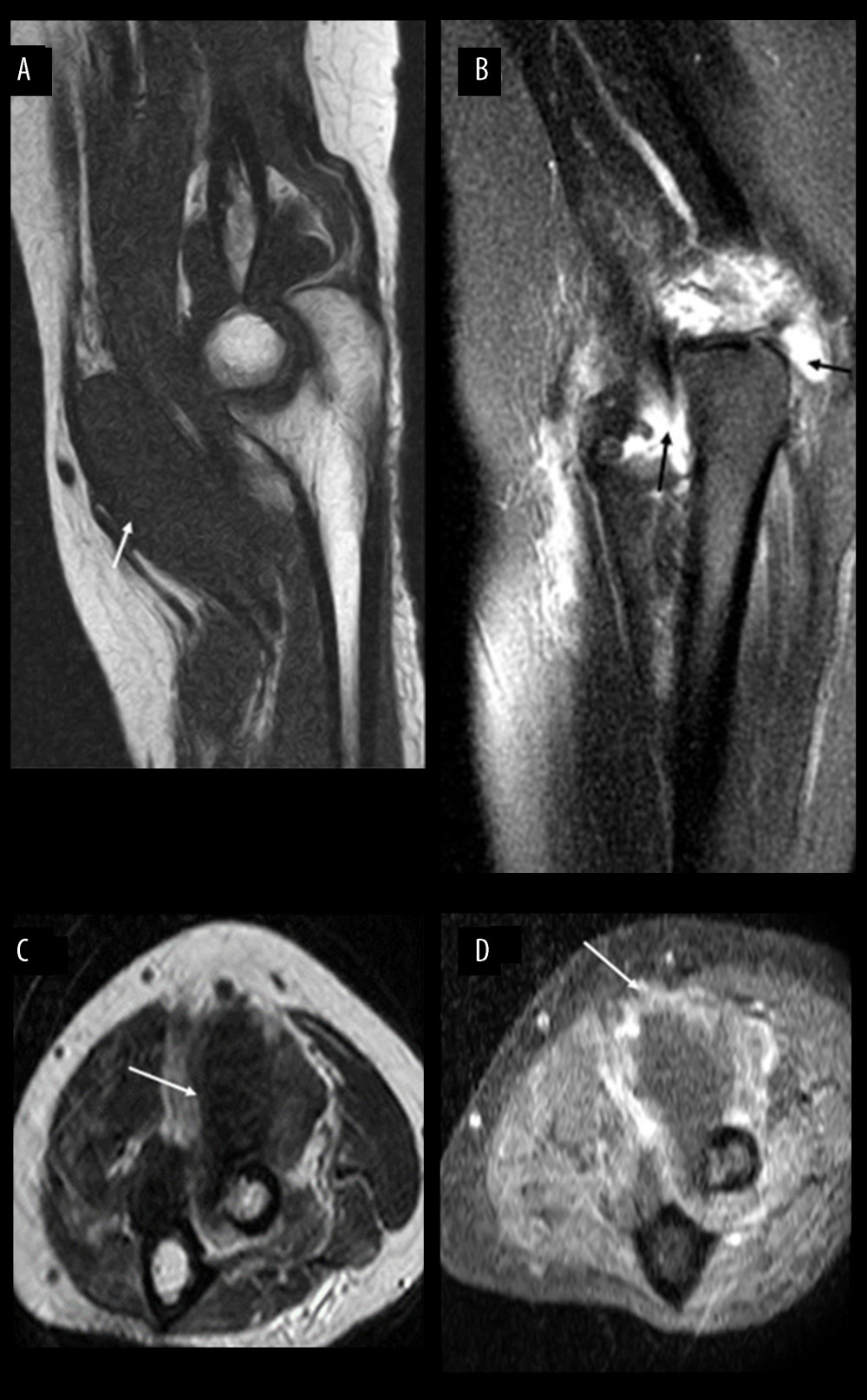 Magnetic resonance imaging of the elbow. (A, B) Sagittal section (left to right T1-weighted [T1W], T2-weighted fat-suppressed [T2FS]). (C) Axial T1-weighted, (D) post-gadolinium contrast imaging. A slight effusion was present in the anterior and posterior recessus joint, with an hyperintense signal on T2W sequence (black arrow). There is extensive effusion of the bicipitoradial bursa, with synovial thickening that is low signal intensity on T1W and T2FS sequences and mild peripheral enhancement after contrast (D) (white arrow), consistent with bicipitoradial bursitis.