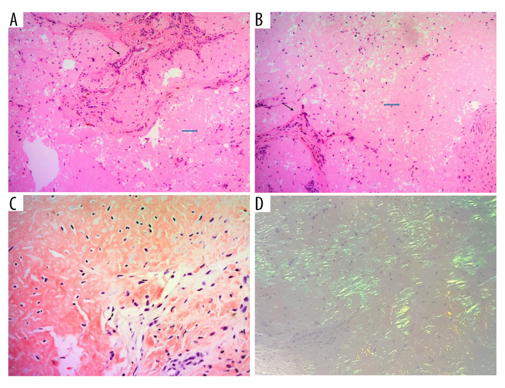 Histological findings from right shoulder specimen. (A, B) Hematoxylin-eosin staining: photomicrograph showing pink material deposition (green arrow), fibrous septal invasion by lymphocytes (black arrow), and increased stromal cellularity in part due to infiltrating large mononuclear cells. (C, D) Show amyloid deposition by Congo red staining: (C) red deposits as seen in un-polarizing light, and (D) typical apple-green birefringence seen under polarizing light.