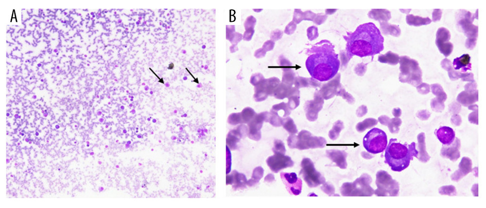 Bone marrow plasma cells. (A) The increase of plasma cells (black arrow) in the bone marrow (Giemsa staining, ×10). (B) Abnormal (atypical) plasma cells (black arrow) (Giemsa staining, ×100).