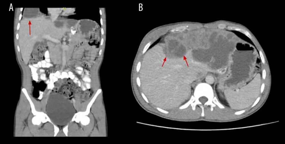 (A) Thoracoabdominal CT scan, coronal plane. (B) Thoracoabdominal CT scan, transverse plane. Focal lesions in the left hepatic lobe, hypodense, multiseptate, with a transverse diameter of 152 mm and subphrenic extension.