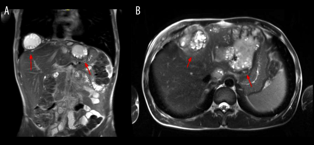(A) Abdominal MRI with contrast, coronal plane. (B) Abdominal MRI with contrast, transverse plane. Multiloculated cystic mass, which is hyperintense in T2, hypointense in T1, with diffusion restriction and peripheral enhancement postcontrast. It involves the hepatic parenchyma (segments I, II, and IV), subphrenic space and the right hemidiaphragm, with approximate dimensions of 50×106×171 mm. At the base of the right hemithorax, an image of similar characteristics is identified, which has dimensions of 48×76×71 mm. In the hepatic segment II, a small 8-mm cyst is identified.