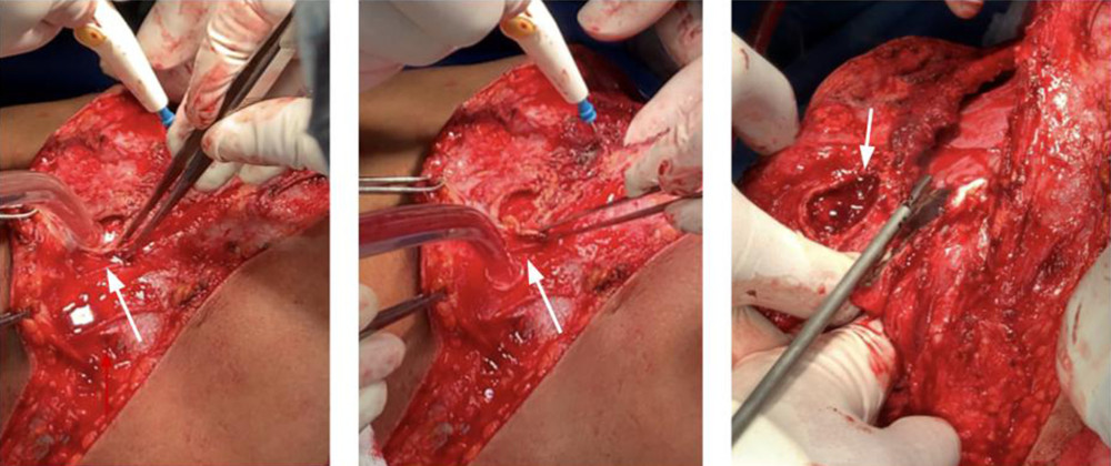 Hydatid cyst adhered to the right lower pulmonary lobe and ipsilateral hemidiaphragm. The capsule of the cyst is indicated by the white arrow; it involved subcutaneous tissue through the thoracic wall. With aspiration active purulent secretion was obtained, which indicated an internal communication with a deep superinfected collection.