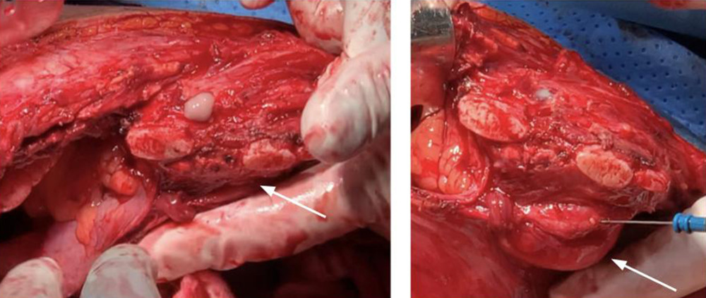 Purulent collection in right thoracic wall. During thoracotomy, a purulent collection through the thoracic wall was identified. It had extensive compromise that included connective tissue, muscle and the costal cartilage of the 6th, 7th, and 8th right costal arch. White arrow shows a cyst adhering to the right lung and the diaphragm, which internally communicated with the active drain point of the purulent collection.