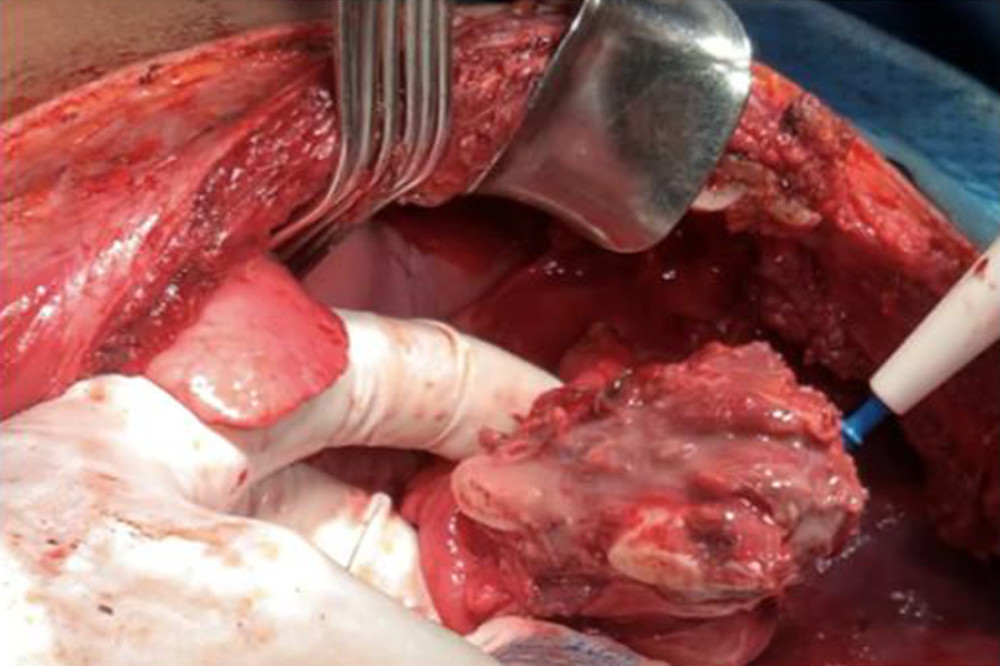 Joint resection of diaphragm and pulmonary segment. After identifying the extension of the lung lesion, a non-anatomic dissection of the right lower lobe was performed, which included the cystic lesion. After that, the visualization of the diaphragm showed multiple cyst seeding; therefor, a partial portion of the diaphragm was dissected and posteriorly resected with joint extraction of the pulmonary segment.