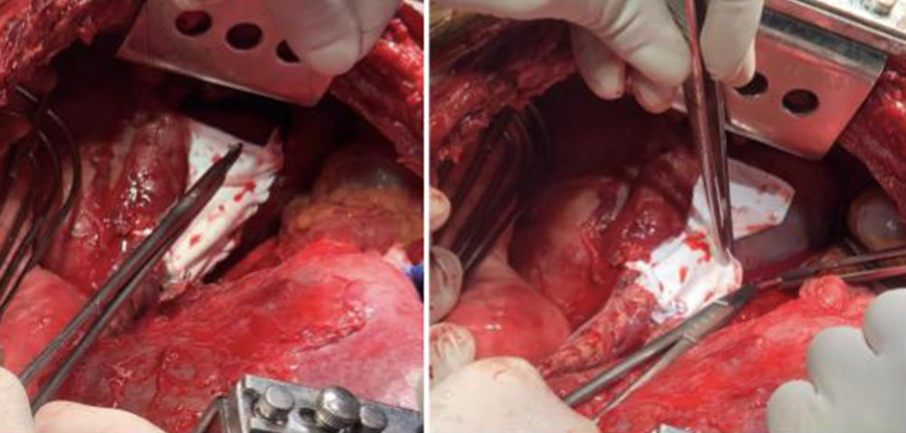 Pericardiectomy with pericardial reconstruction. Pericardial cysts were visualized in the fibrous layer of the pericardium surface. A partial pericardiectomy plus cyst resection is done with pericardial reconstruction with synthetic patch anchored to pericardial remnants with 5-0 synthetic, monofilament, nonabsorbable polypropylene suture.