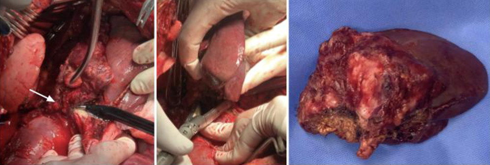 Left hepatectomy. Using extracorporeal circulation and through a previous thoraco-phreno-laparotomy incision, the release from the retro hepatic vena cava of the cyst that compromised left liver including segment I, was achieved. Using bipolar energy device, dissection of the hepatic tissue was made and a left hepatectomy plus cystectomy was performed.