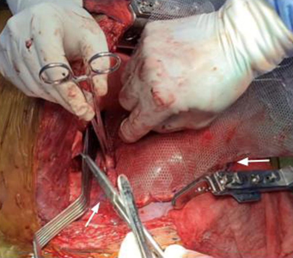 Diaphragm repair with synthetic mesh. After the resection and extraction of all the compromised structures (lung, diaphragm, pericardium and liver), the diaphragm was repaired with a composite mesh made of monofilament polyester on one side and hydrophilic absorbable collagen film on the other. The Parietex mesh was fixed to the anterior diaphragmatic remnant and then to the right and left remnant.