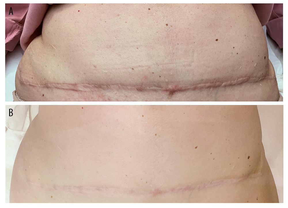Aesthetic improvement of the patient’s suprapubic abdominal scar before (A) and 60 days after the last treatment session (B) (6-month follow-up).