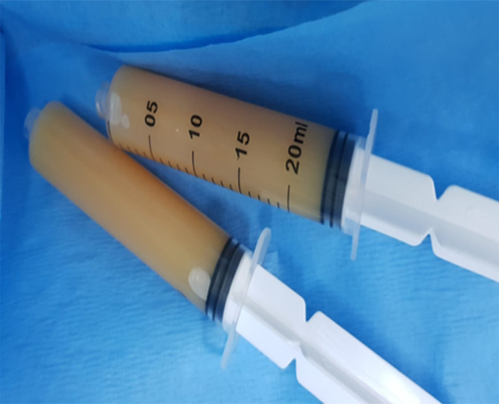 Chylous ascites in paracentesis syringes.