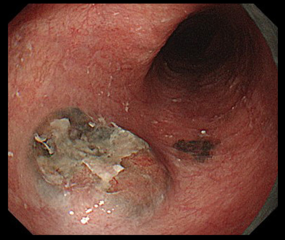 Known esophageal melanosis observed 26–28 cm from the upper incisor, and a 0-IIa lesion observed at the same site.