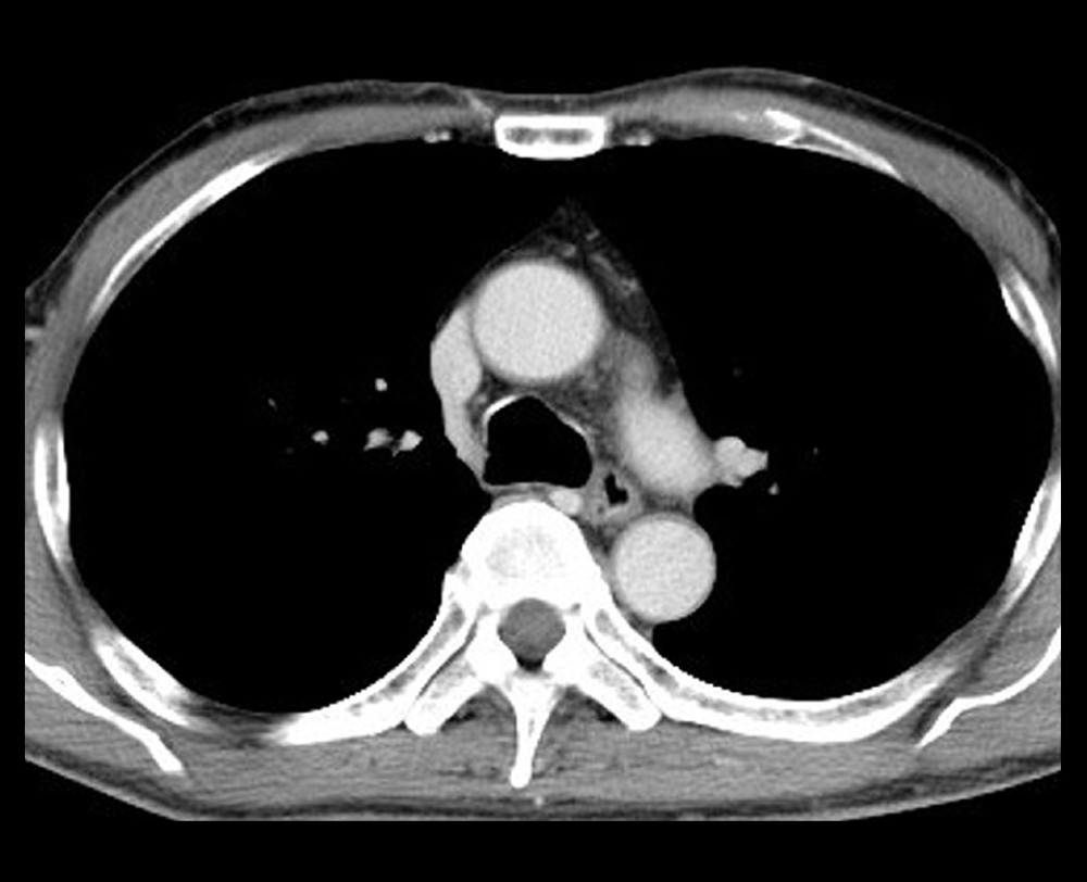 Computed tomography (CT) showing a slight contrast effect on the esophageal wall and no obvious metastasis to lymph nodes or other organs.