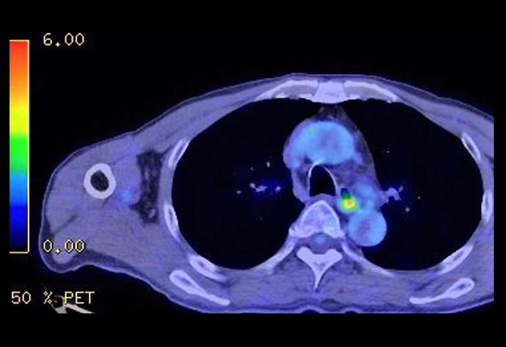 Positron emission tomography/CT showing the accumulation of SUV max of 4.33 at the tracheal bifurcation level of the thoracic esophagus. CT, computed tomography; SUV max, maximum standardized uptake value.